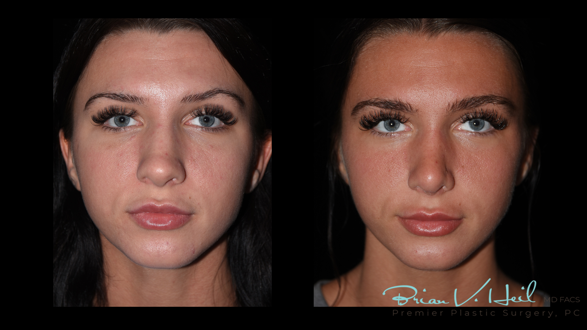 Rhinoplasty in Pittsburgh, PA