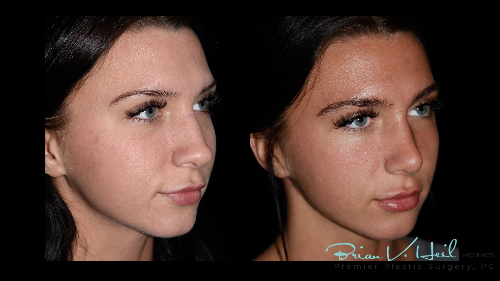 Rhinoplasty in Pittsburgh, PA