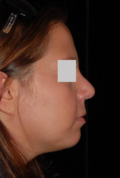 Rhinoplasty Before and After | Premier Plastic Surgery
