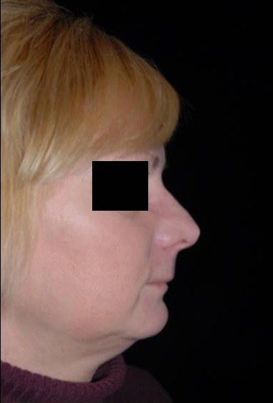 Rhinoplasty Before and After | Premier Plastic Surgery