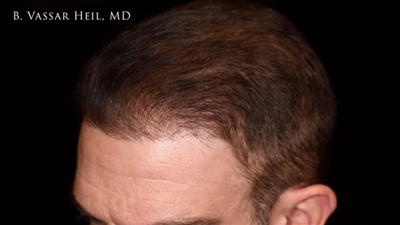 ARTAS Hair Transplant in Pittsburgh, PA